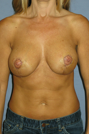 Breast Lift Before & After Patient #4006