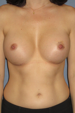 Breast Lift Before & After Patient #4018