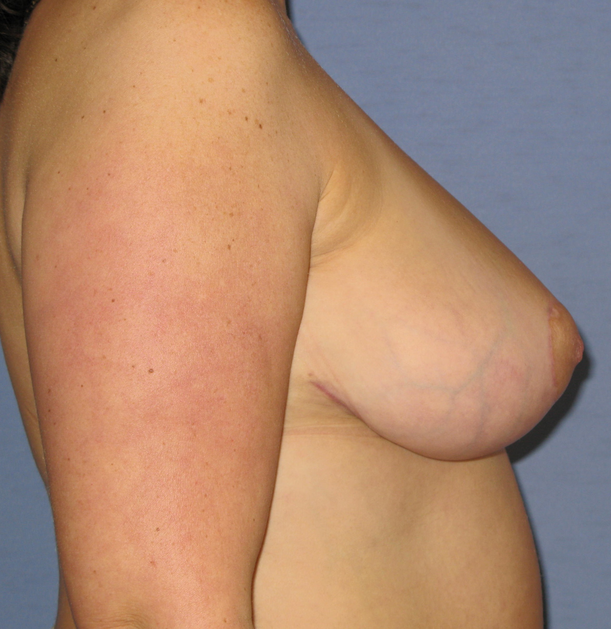 Breast Lift Before & After Patient #4026