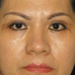 Eyelid Surgery Before & After Patient #3618