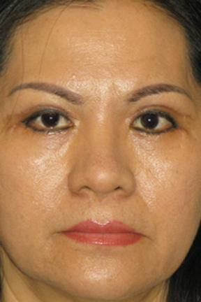 Eyelid Surgery Before & After Patient #3618