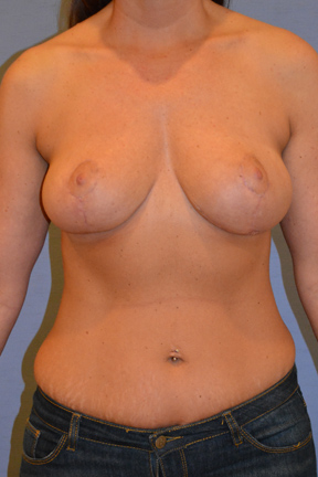 Breast Lift Before & After Patient #3569