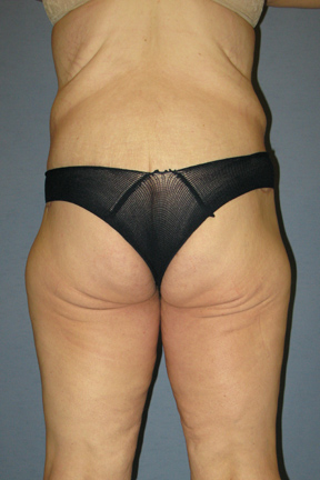 Body Lift Before & After Patient #3556