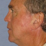 Facelift Before & After Patient #4072