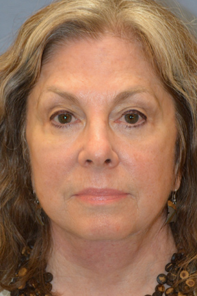 Facelift Before & After Patient #4062