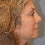 Facelift Before & After Patient #4062