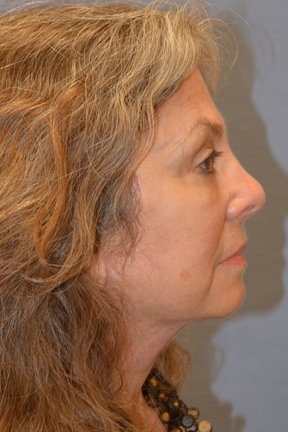 Facelift Before & After Patient #4062