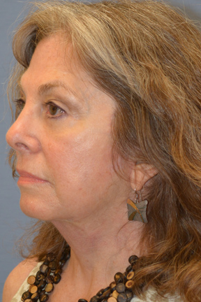 Facelift Before & After Patient #4062