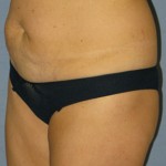 Tummy Tuck Before & After Patient #3582