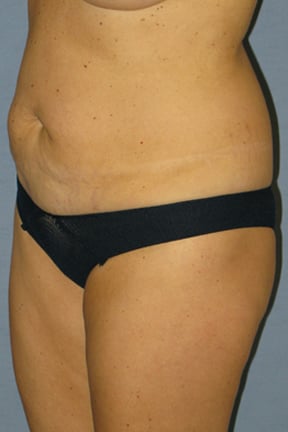 Tummy Tuck Before & After Patient #3582