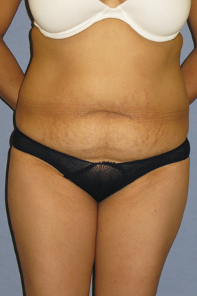 Tummy Tuck Before & After Patient #3596