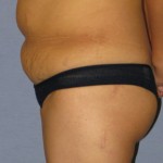 Tummy Tuck Before & After Patient #3596