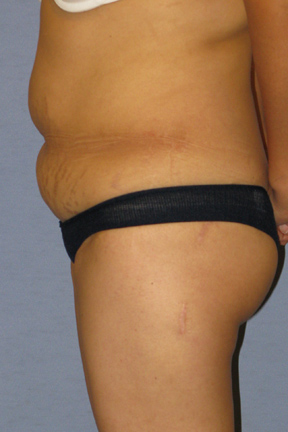 Tummy Tuck Before & After Patient #3596