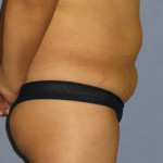 Tummy Tuck Before & After Patient #3596