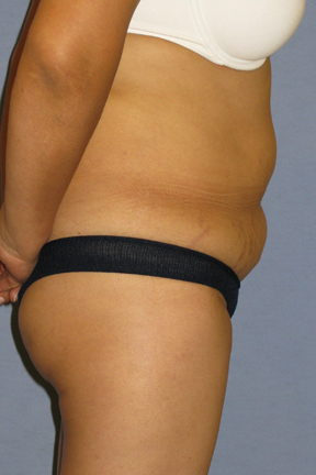 Tummy Tuck Before & After Patient #3596