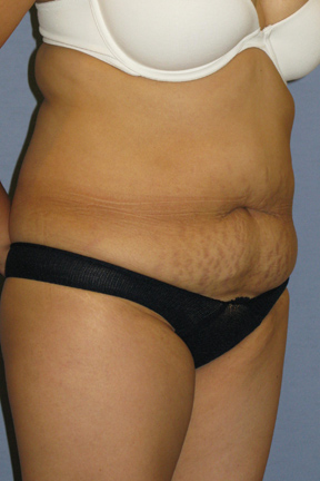 Tummy Tuck Before & After Patient #3596