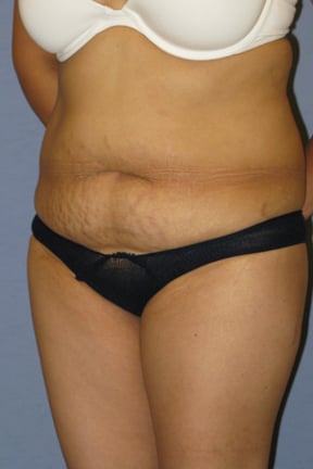 Tummy Tuck Before & After Patient #3596