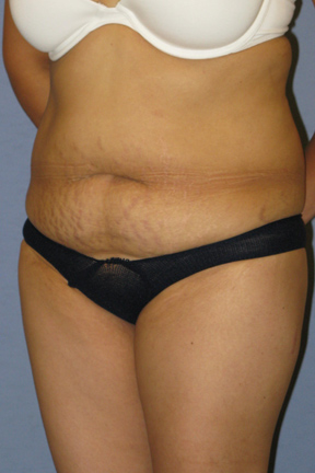 Tummy Tuck Before & After Patient #3596