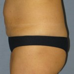 Tummy Tuck Before & After Patient #3582