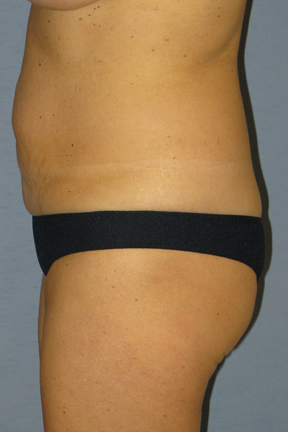 Tummy Tuck Before & After Patient #3582