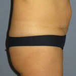 Tummy Tuck Before & After Patient #3582