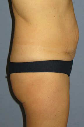 Tummy Tuck Before & After Patient #3582