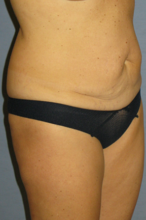 Tummy Tuck Before & After Patient #3582