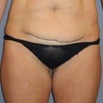 Tummy Tuck Before & After Patient #3591