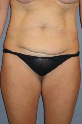 Tummy Tuck Before & After Patient #3591