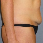 Tummy Tuck Before & After Patient #3591