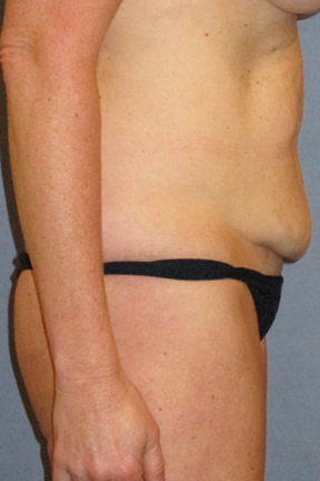 Tummy Tuck Before & After Patient #3591