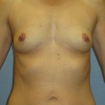 Breast Augmentation Before & After Patient #3674