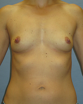 Breast Augmentation Before & After Patient #3674