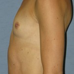 Breast Augmentation Before & After Patient #3628