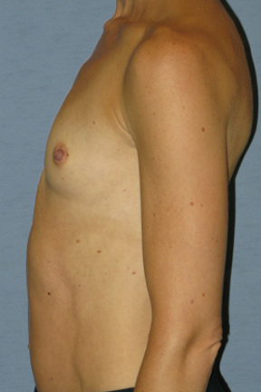 Breast Augmentation Before & After Patient #3628