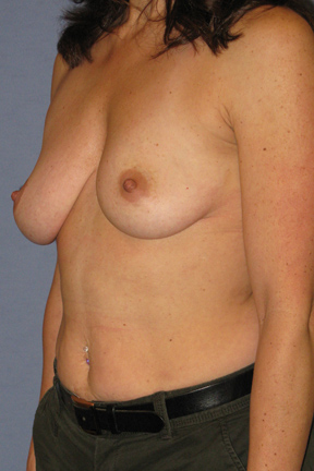 Breast Augmentation Before & After Patient #3825
