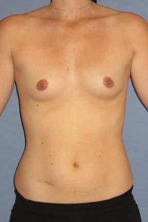 Breast Augmentation Before & After Patient #3652