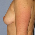 Breast Augmentation Before & After Patient #3825