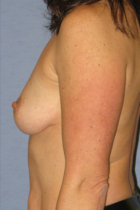 Breast Augmentation Before & After Patient #3825