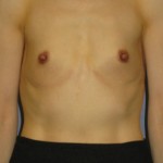 Breast Augmentation Before & After Patient #3832