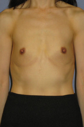 Breast Augmentation Before & After Patient #3832