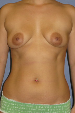 Breast Augmentation Before & After Patient #3835