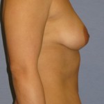 Breast Augmentation Before & After Patient #3835