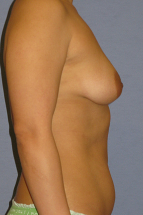 Breast Augmentation Before & After Patient #3835