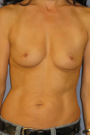 Breast Augmentation Before & After Patient #3842