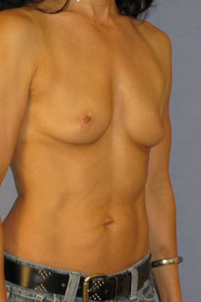Breast Augmentation Before & After Patient #3842