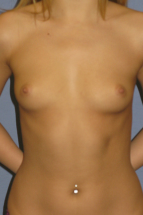 Breast Augmentation Before & After Patient #3849