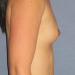 Breast Augmentation Before & After Patient #3652