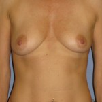Breast Augmentation Before & After Patient #3856