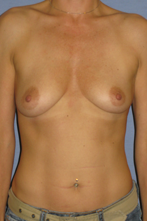 Breast Augmentation Before & After Patient #3856